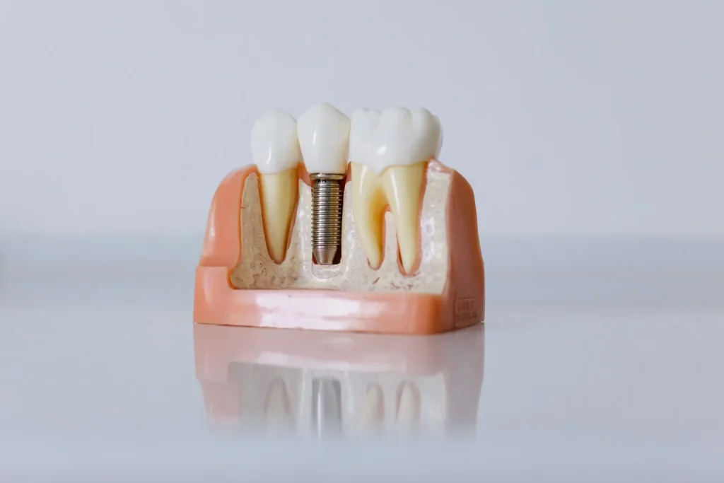 Custom dental crowns for restoring damaged teeth