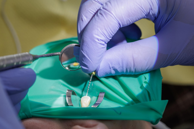 Root canal procedure to treat infected tooth