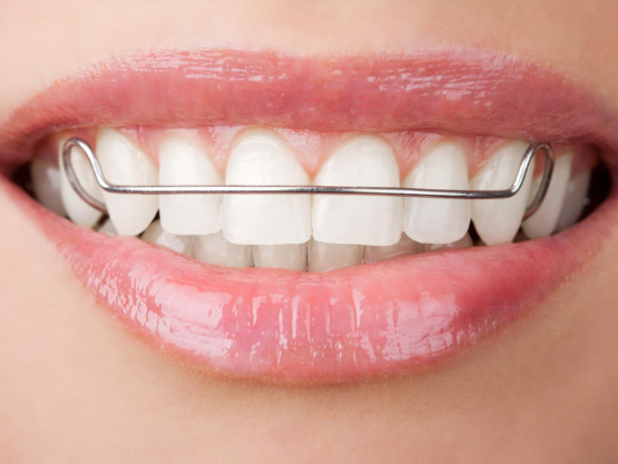 Orthodontic retainer for maintaining teeth alignment