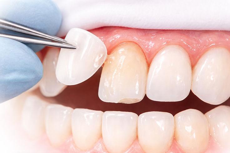Porcelain veneers treatment for smile enhancement