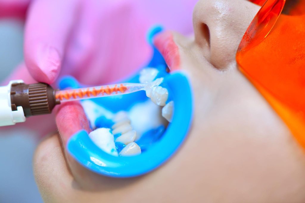 Professional teeth whitening treatment
