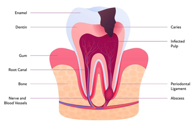 Tooth infection and root canal anatomy