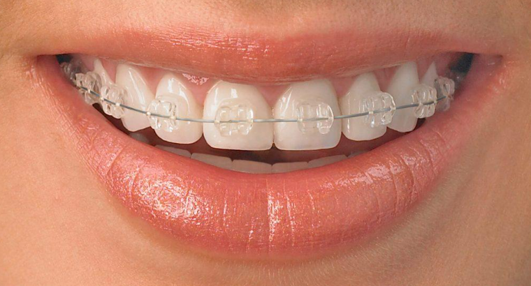 Orthodontist Services in Tacoma