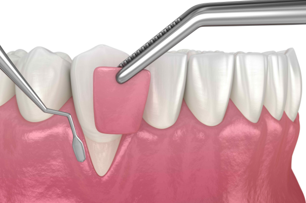 Crown lengthening dental procedure for gum and tooth treatment