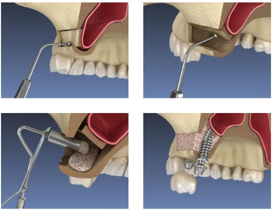 Dentist discussing oral surgery treatment with a patient