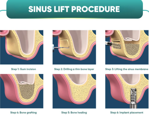 Sinus lift procedure for dental implant preparation