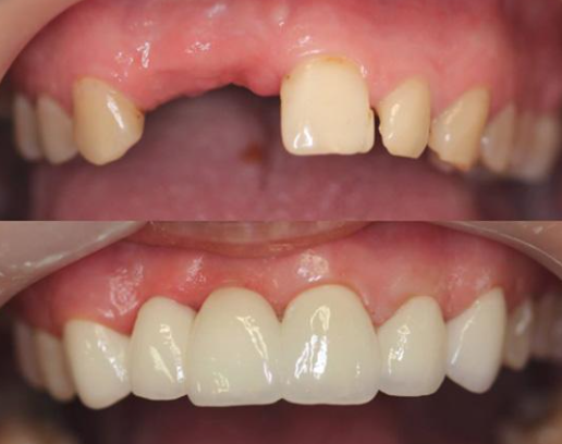 Dental bridge being fitted during a restorative dental procedure