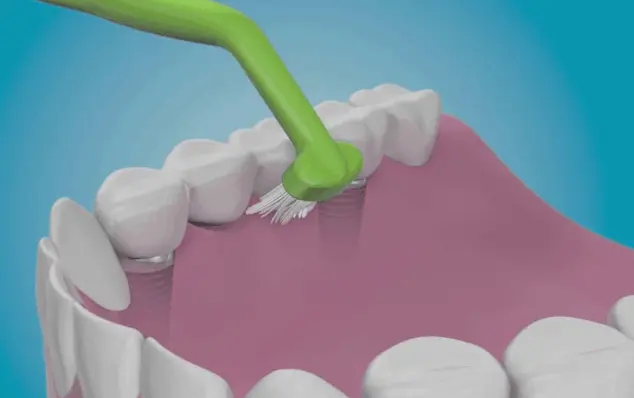 Cleaning around a dental implant with proper oral hygiene