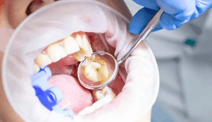 Dentist examining a damaged tooth for restorative treatment