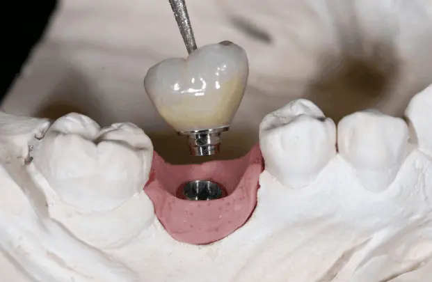 Dental implant model showing implant and replacement tooth