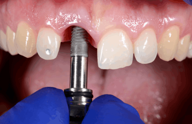 Dental implant placement for a single missing tooth