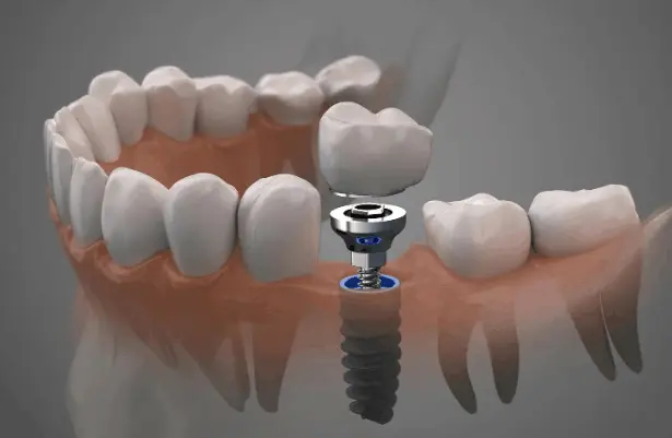 Dental implant restoration repair and replacement illustration