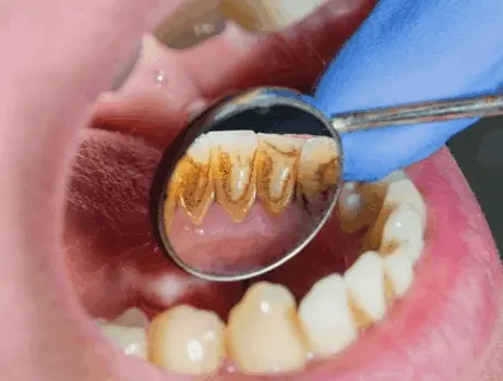 Dental professional performing periodontal deep cleaning