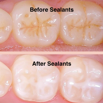 Dental sealant protecting the grooves of a back tooth