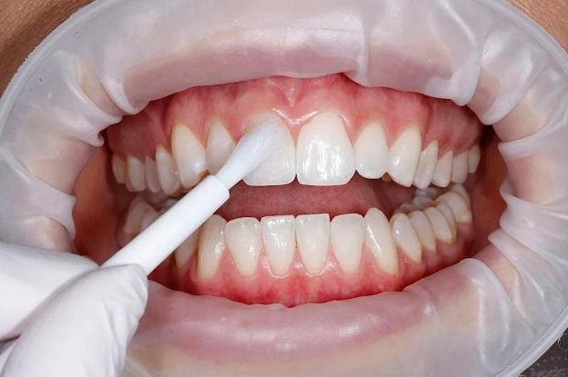 Professional fluoride treatment being applied to protect tooth enamel