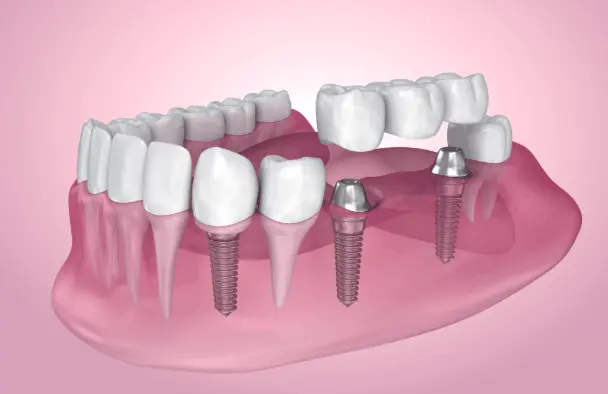 Implant-supported restoration replacing multiple missing teeth