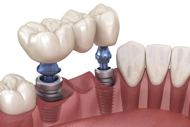 Multiple dental implants replacing missing teeth