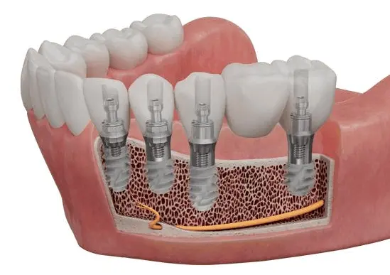 Multiple dental implants placed in the jawbone