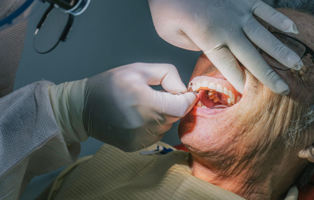 Natural-looking dentures restoring a complete smile