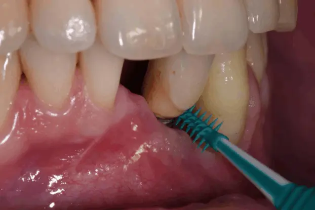 Patient caring for dental implant with proper oral hygiene