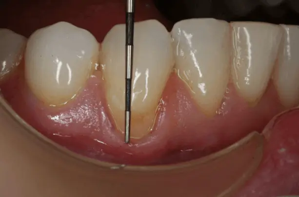 Periodontal pocket depth measurement during gum examination