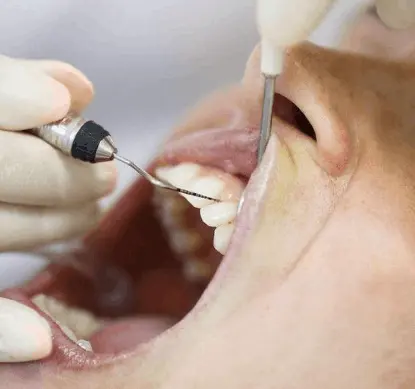 Scaling and root planing procedure on a tooth root