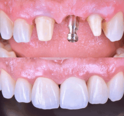 Single-tooth dental implant replacing a missing tooth