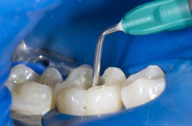 Composite material being applied during a dental filling procedure