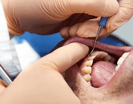 Periodontal deep cleaning being performed below the gumline