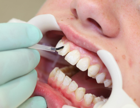 Composite resin being applied during a dental bonding procedure