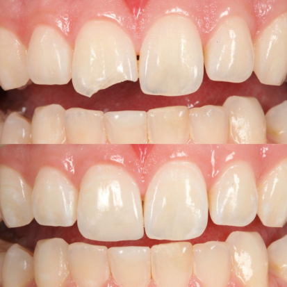 Dental bonding before and after for a chipped front tooth