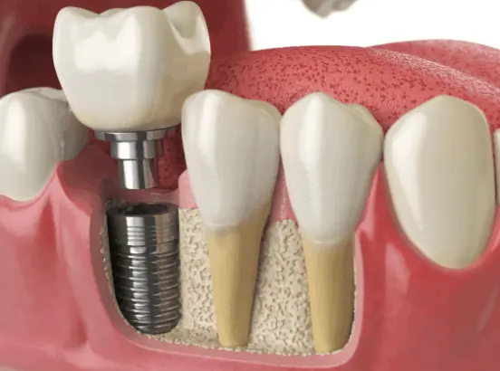 Dental implant restoration with abutment and crown