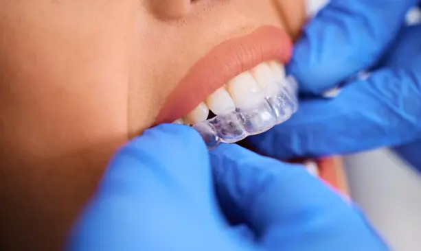 Clear orthodontic aligner fitted over teeth