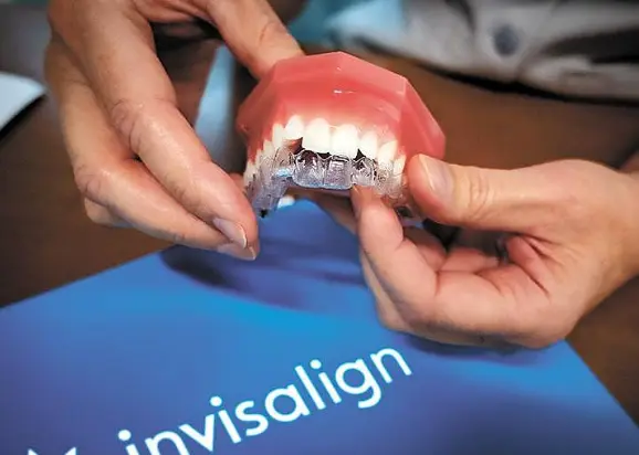 Clear aligners shown on a dental model