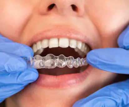 Clear dental retainer designed to maintain tooth alignment