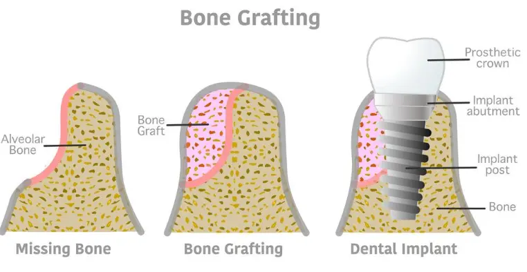 3D illustration of bone graft supporting a dental implant