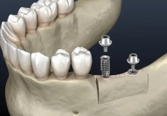 insufficient jawbone before dental bone grafting
