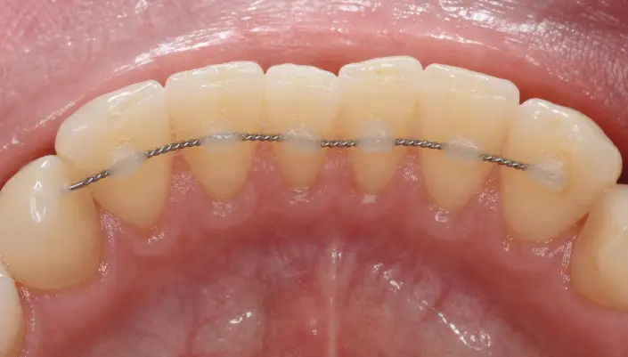 Fixed retainer bonded behind the front teeth