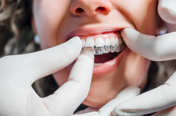 Invisalign clear aligners for straightening teeth