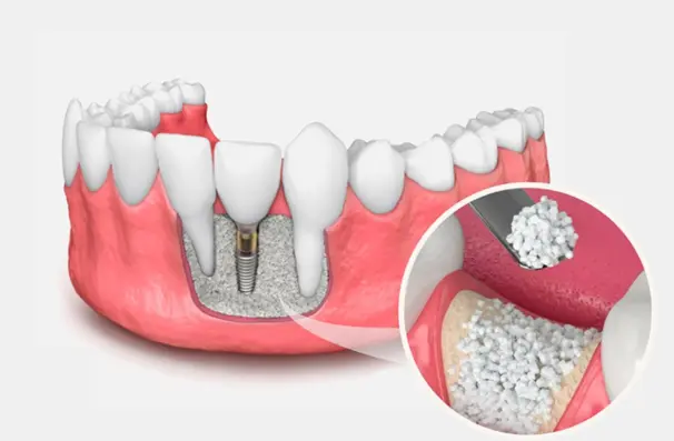 3D illustration showing insufficient jawbone before dental bone grafting